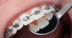 Cum să ai un zâmbet perfect cu ajutorul unui aparat dentar?