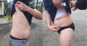 Cum arată trupul unei persoane care a supraviețuit după ce a fost lovită de un fulger (FOTO)